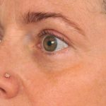 Eyelid Surgery Before & After Patient #1550