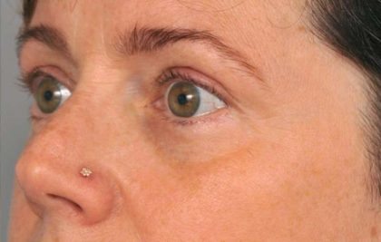 Eyelid Surgery Before & After Patient #1550
