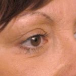 Eyelid Surgery Before & After Patient #1557