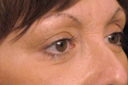 Eyelid Surgery Before & After Patient #1557