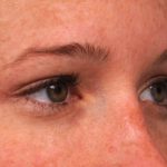 Eyelid Surgery Before & After Patient #1565