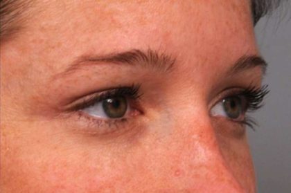 Eyelid Surgery Before & After Patient #1565