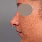 Rhinoplasty Before & After Patient #1572