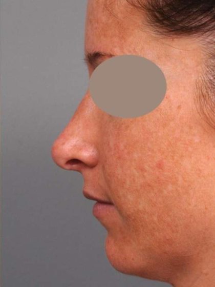 Rhinoplasty Before & After Patient #1572
