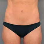 Tummy Tuck Before & After Patient #363
