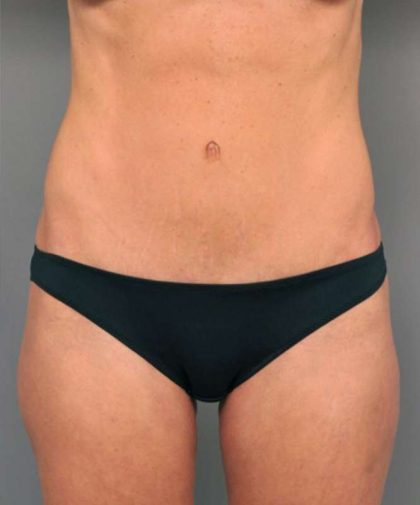 Tummy Tuck Before & After Patient #363