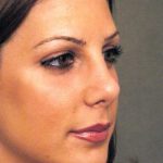 Rhinoplasty Before & After Patient #1579