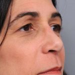 Rhinoplasty Before & After Patient #1586