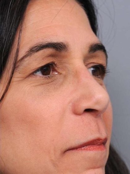 Rhinoplasty Before & After Patient #1586