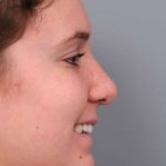 Rhinoplasty Before & After Patient #1591