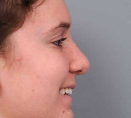 Rhinoplasty Before & After Patient #1591