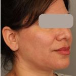 Neck Lift (Traditional) Before & After Patient #1596