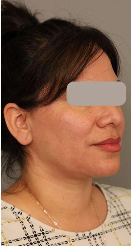 Neck Lift (Traditional) Before & After Patient #1596