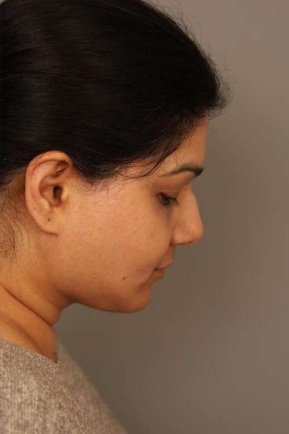 Neck Lift (Traditional) Before & After Patient #1605