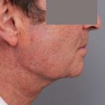 Neck Lift (Traditional) Before & After Patient #1612