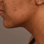 Neck Lift (Traditional) Before & After Patient #1621
