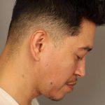 Mini Neck Lift (Single Incision) Before & After Patient #1630