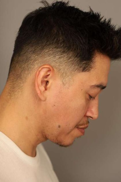 Mini Neck Lift (Single Incision) Before & After Patient #1630