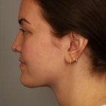 Mini Neck Lift (Single Incision) Before & After Patient #1637
