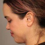 Mini Neck Lift (Single Incision) Before & After Patient #1646