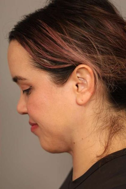 Mini Neck Lift (Single Incision) Before & After Patient #1646