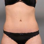 Tummy Tuck Before & After Patient #370