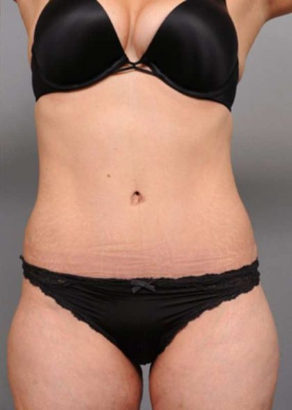 Tummy Tuck Before & After Patient #370