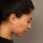 Mini Neck Lift (Single Incision) Before & After Patient #1662