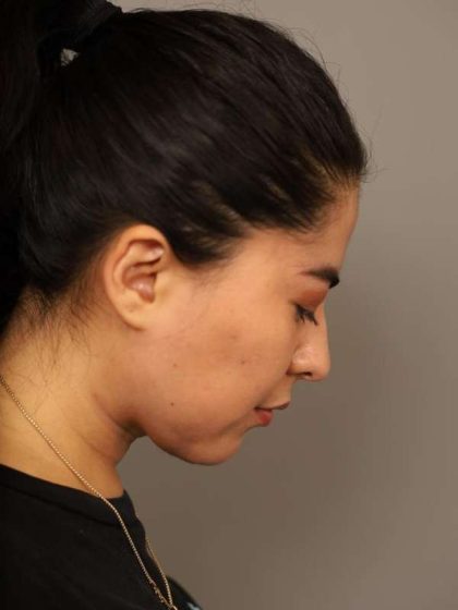 Mini Neck Lift (Single Incision) Before & After Patient #1662