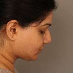 Mini Neck Lift (Single Incision) Before & After Patient #1671