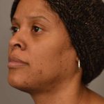 Mini Neck Lift (Single Incision) Before & After Patient #1679