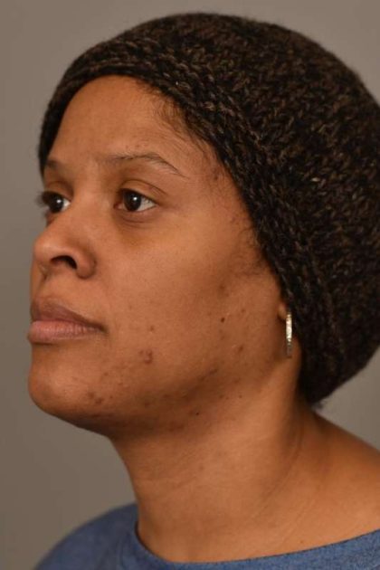 Mini Neck Lift (Single Incision) Before & After Patient #1679