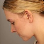 Mini Neck Lift (Single Incision) Before & After Patient #1690