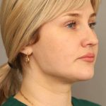 Neck Liposuction / Chin Liposuction Before & After Patient #1703