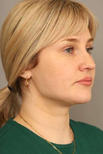 Neck Liposuction / Chin Liposuction Before & After Patient #1703