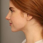 Neck Liposuction / Chin Liposuction Before & After Patient #1719
