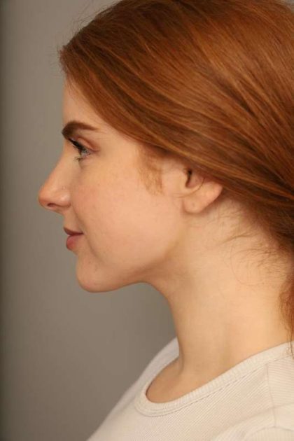 Neck Liposuction / Chin Liposuction Before & After Patient #1719