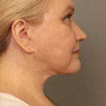 Neck Liposuction / Chin Liposuction Before & After Patient #1743