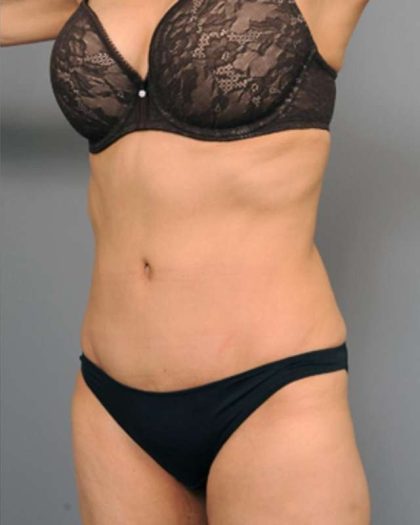 Tummy Tuck Before & After Patient #377