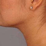 Neck Liposuction / Chin Liposuction Before & After Patient #1770
