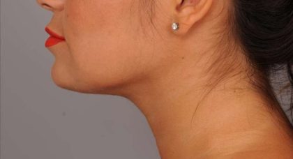 Neck Liposuction / Chin Liposuction Before & After Patient #1770