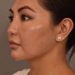 Neck Liposuction / Chin Liposuction Before & After Patient #1781