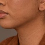 Neck Liposuction / Chin Liposuction Before & After Patient #1787