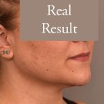 Neck Liposuction / Chin Liposuction Before & After Patient #1794