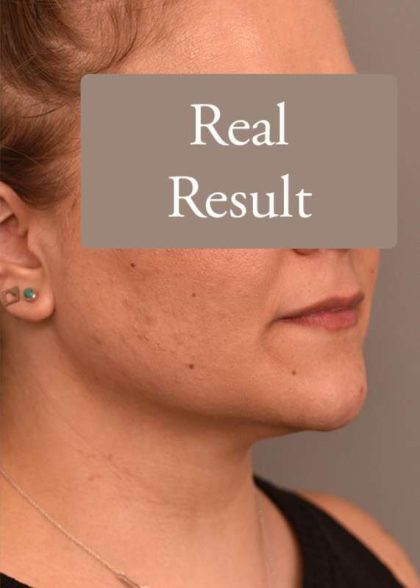 Neck Liposuction / Chin Liposuction Before & After Patient #1794
