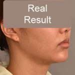 Neck Liposuction / Chin Liposuction Before & After Patient #1801
