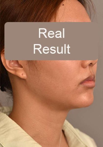 Neck Liposuction / Chin Liposuction Before & After Patient #1801