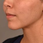 Neck Liposuction / Chin Liposuction Before & After Patient #1806
