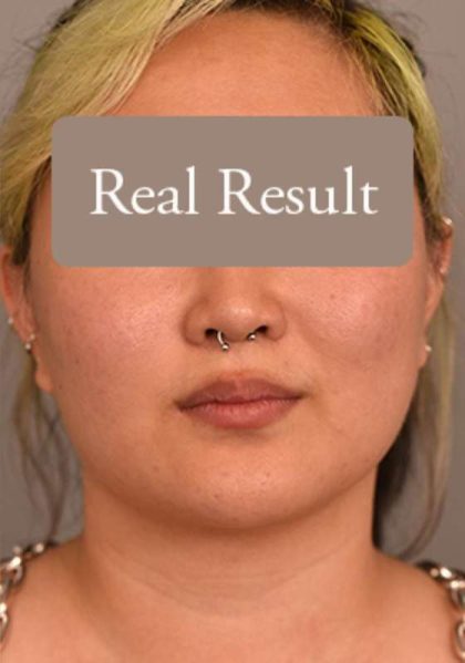 Neck Liposuction / Chin Liposuction Before & After Patient #1816