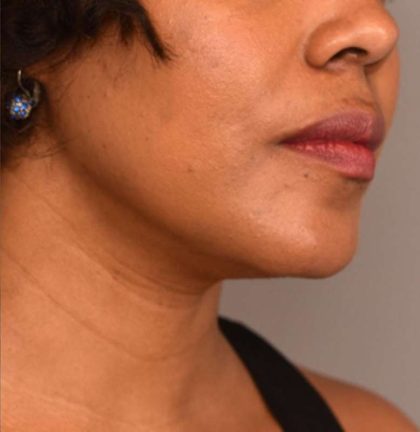 Neck Liposuction / Chin Liposuction Before & After Patient #1824